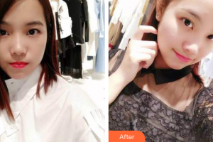 佛山中大口腔醫(yī)院林海權(quán)整形價(jià)格表附時(shí)代天使矯正案例展示