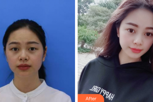 佛山美萊醫(yī)療美容醫(yī)院劉永揚(yáng)整形價(jià)格表附眼部整形案例展示