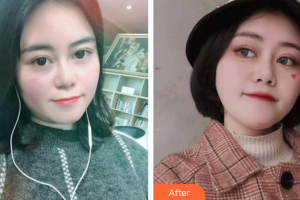 佛山華美整形美容醫(yī)院于洋整形價(jià)格表附埋線提升案例展示