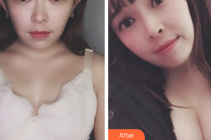 佛山美萊醫(yī)療美容醫(yī)院孫靖整形價(jià)格表附自體脂肪隆胸案例展示