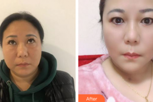 佛山醫(yī)博士醫(yī)療美容門診部陳偉彬整形價(jià)格表附外切去眼袋案例展示