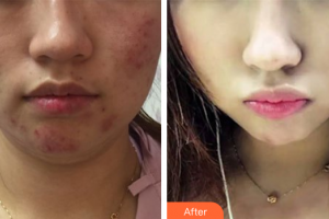 佛山醫(yī)博士醫(yī)療美容門診部鄧勤煥整形價(jià)格表附果酸活膚祛痘案例展示