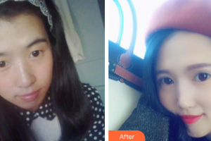 佛山凱瑟琳醫(yī)學(xué)美容醫(yī)院歐陽(yáng)海濱整形價(jià)格表附明眸眼部手術(shù)案例展示