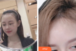 佛山華美整形美容醫(yī)院肖吉輔整形價(jià)格表附種植發(fā)際線案例展示