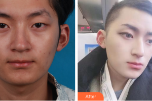 佛山凱瑟琳醫(yī)學(xué)美容醫(yī)院劉生整形價(jià)格表附眼部整形案例展示