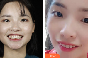佛山君美醫(yī)療美容醫(yī)院黃海整形價(jià)格表附牙齒矯正案例展示