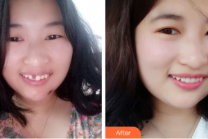 佛山君美醫(yī)療美容醫(yī)院王麗君整形價(jià)格表附種植牙案例展示