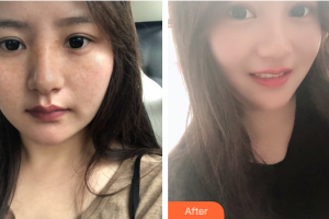 佛山市禪城中心醫(yī)院整形美容科羅春源整形價(jià)格表附祛雀斑案例展示