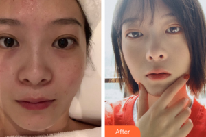 佛山廣大壹美醫(yī)療美容門診部龍博整形價(jià)格表附小氣泡案例展示