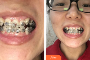 佛山君美醫(yī)療美容醫(yī)院鄭旭輝整形價(jià)格表附金屬矯正案例展示