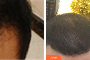 佛山廣大壹美醫(yī)療美容門診部李青輝整形價(jià)格表附種植發(fā)際線案例展示