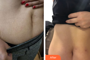 佛山廣大壹美醫(yī)療美容門診部謝舜賢整形價(jià)格表附祛妊娠紋案例展示