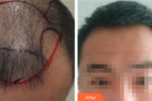 佛山廣大壹美醫(yī)療美容門診部應(yīng)曉紅整形價(jià)格表附種植發(fā)際線案例展示