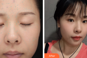 佛山華廈眼科醫(yī)院徐莉整形價(jià)格表附美白嫩膚NIR牛奶光案例展示