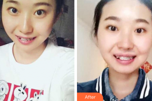 佛山拜博口腔醫(yī)院林寶輝整形價(jià)格表附自鎖托槽矯正案例展示