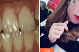 佛山拜博口腔醫(yī)院孟偉整形價(jià)格表附隱適美牙齒矯正案例展示