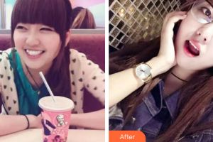 佛山拜博口腔醫(yī)院駱?biāo)既A整形價(jià)格表附金屬矯正案例展示