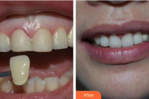 佛山拜博口腔醫(yī)院余敏整形價(jià)格表附口腔美學(xué)貼面案例展示