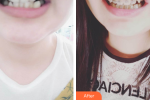 佛山拜博口腔醫(yī)院林江琛整形價(jià)格表附自鎖矯正案例展示