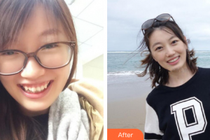 佛山順德口腔醫(yī)院吳蘭萍整形價(jià)格表附金屬矯正案例展示