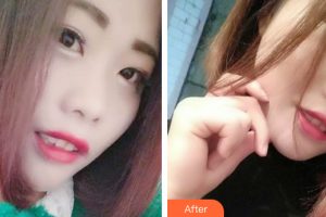 佛山南海中大口腔醫(yī)院吳成坤整形價(jià)格表附超聲波洗牙案例展示