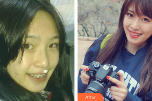 佛山市禪城區(qū)人民醫(yī)院口腔?？漆t(yī)院許家鏘整形價(jià)格表附金屬矯正案例展示