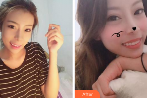 佛山市禪城區(qū)人民醫(yī)院口腔?？漆t(yī)院關達榮整形價格表附隱形矯正案例展示