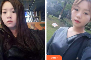 佛山市禪城區(qū)人民醫(yī)院口腔專科醫(yī)院陳月明整形價(jià)格表附時(shí)代天使矯正案例展示