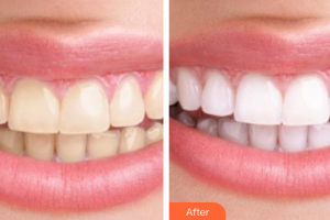 佛山市禪城區(qū)人民醫(yī)院口腔?？漆t(yī)院莫振飛整形價格表附冷光美白案例展示