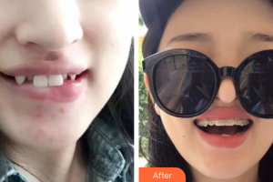 佛山南海中大口腔醫(yī)院謝建雅整形價格表附金屬矯正案例展示