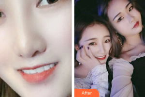 佛山順德口腔醫(yī)院吳龍華整形價格表附瓷貼面案例展示