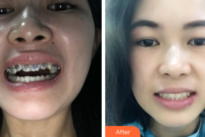 佛山順德口腔醫(yī)院余興華整形價格表附金屬矯正案例展示