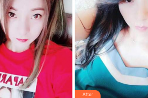 佛山南海中大口腔醫(yī)院陳麗整形價格表附超聲波潔牙案例展示