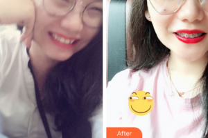 佛山市禪城區(qū)人民醫(yī)院口腔專科醫(yī)院李業(yè)榮整形價格表附金屬矯正案例展示