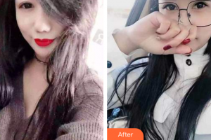 佛山市禪城區(qū)人民醫(yī)院口腔專科醫(yī)院符鎮(zhèn)南整形價格表附時代天使矯正案例展示