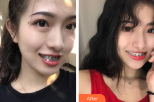 佛山市禪城區(qū)人民醫(yī)院口腔?？漆t(yī)院翟煒東整形價格表附自鎖矯正案例展示