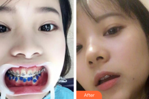 佛山市禪城區(qū)人民醫(yī)院口腔?？漆t(yī)院段昌華整形價格表附金屬矯正案例展示