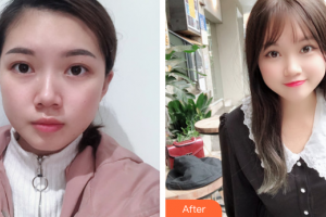 佛山市禪城中心醫(yī)院整形美容科王學煌整形價格表附雙眼皮案例展示