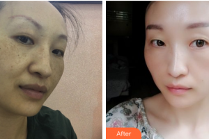 江門?？滇t(yī)學整形美容醫(yī)院徐靖宏整形價格表附祛黃褐斑案例展示