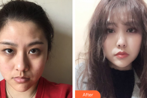 江門瑪麗整形醫(yī)院翁明飛整形價格表附激光去眼袋案例展示