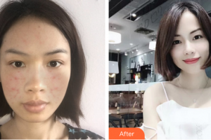 江門瑪麗整形醫(yī)院李慧瓊整形價格表附紅藍光祛痘案例展示