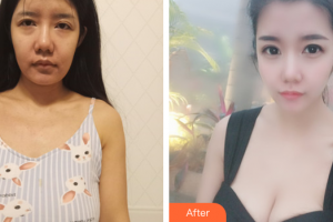 江門?？滇t(yī)學整形美容醫(yī)院張志軍整形價格表附自體脂肪隆胸案例展示