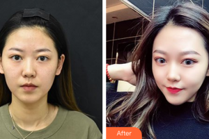 江門西區(qū)醫(yī)院中醫(yī)美容中心楊英整形價格表附光子嫩膚案例展示