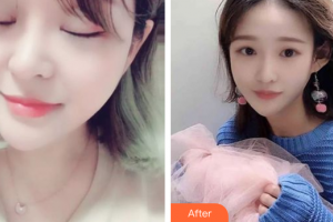 江門西區(qū)醫(yī)院中醫(yī)美容中心張平整形價格表附激光美膚激光案例展示