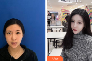 江門西區(qū)醫(yī)院中醫(yī)美容中心巫云整形價格表附熱瑪吉抗衰案例展示