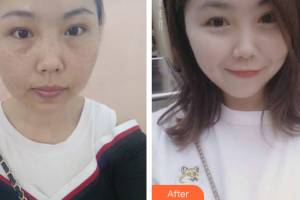 江門?？滇t(yī)學整形美容醫(yī)院李嘉欣整形價格表附祛雀斑案例展示