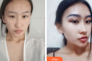 江門?？滇t(yī)學整形美容醫(yī)院付洪波整形價格表附眼部手術案例展示