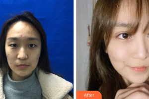 江門僑都華美美容醫(yī)院林社彬院長(zhǎng)整形價(jià)格表附美眼案例展示