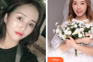 江門僑都華美美容醫(yī)院常海整形價格表附眼部整形案例展示