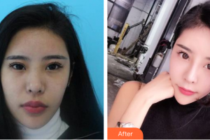 湛江名媛醫(yī)學(xué)美容門診部陳小利整形價(jià)格表附鼻整形案例展示